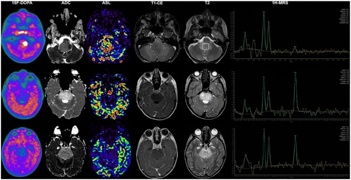 The promise of metabolic imaging in diffuse midline glioma.jpg