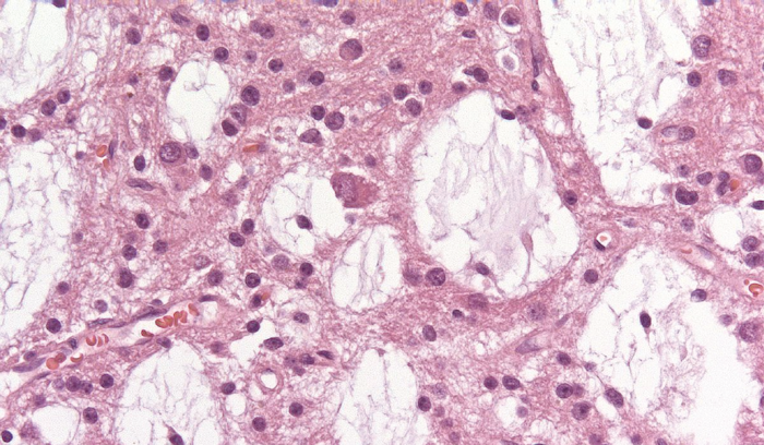 Dysembryoplastic neuroepithelial tumor (DNET).png