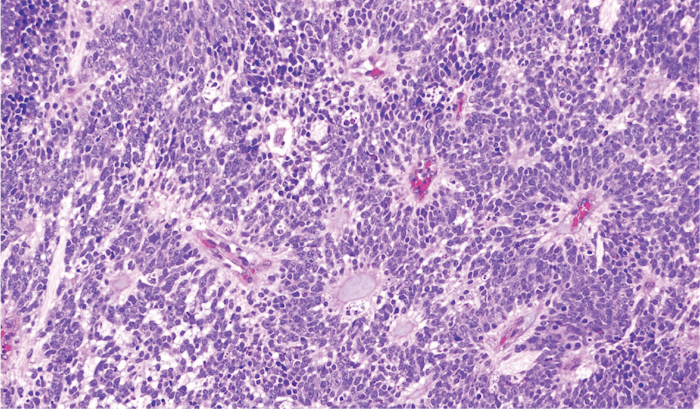 Embryonal Tumor with Multilayered Rosettes.png