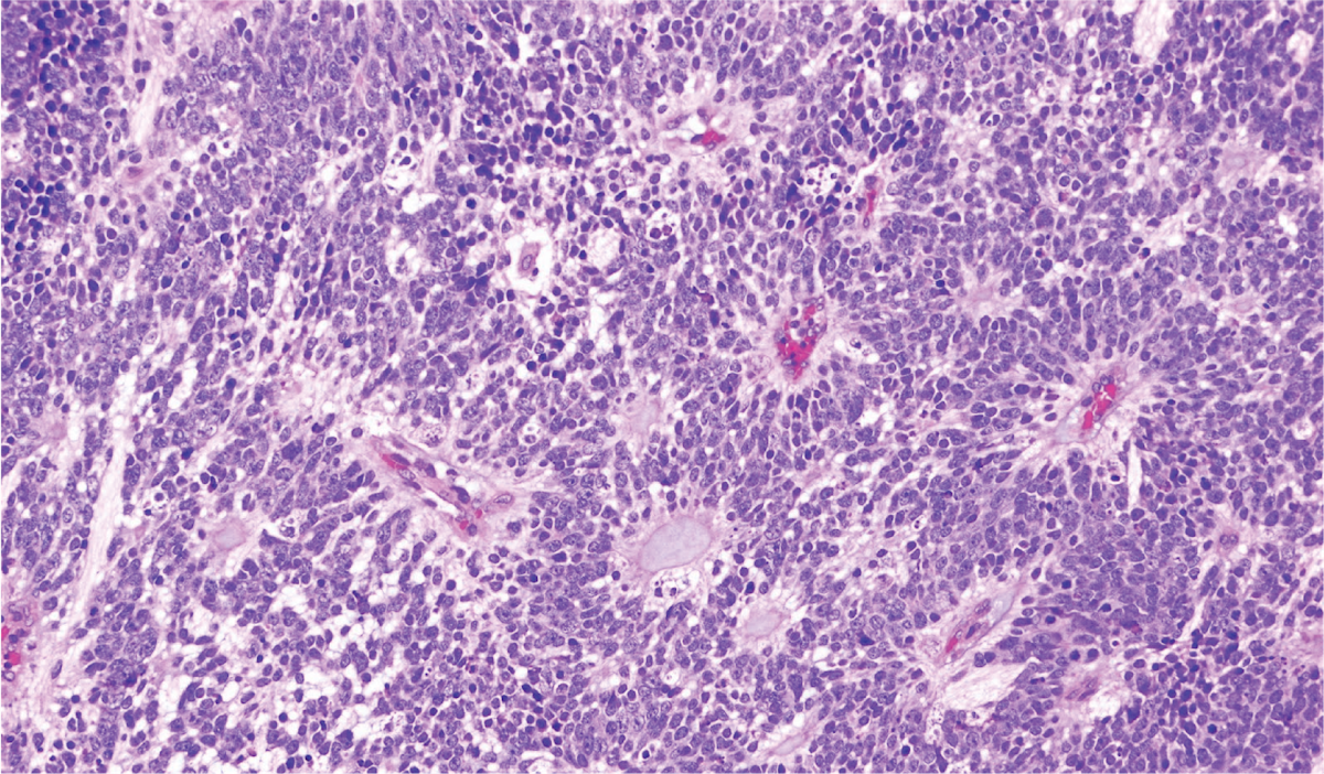 Embryonal Tumor With Multilayered Rosettes 