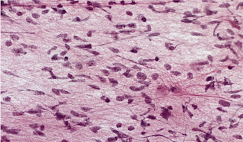 Gliomatosis Cerebri.png