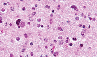 High-grade glioma_astrocytoma (WHO grade III_IV).png