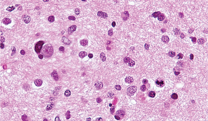 High-grade glioma_astrocytoma (WHO grade III_IV).png