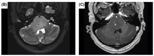 IDH-mutant Brainstem Gliomas In Adolescent And Young Adult Patients ...