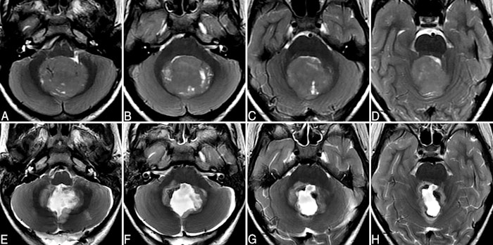 Medulloblastoma.jpg