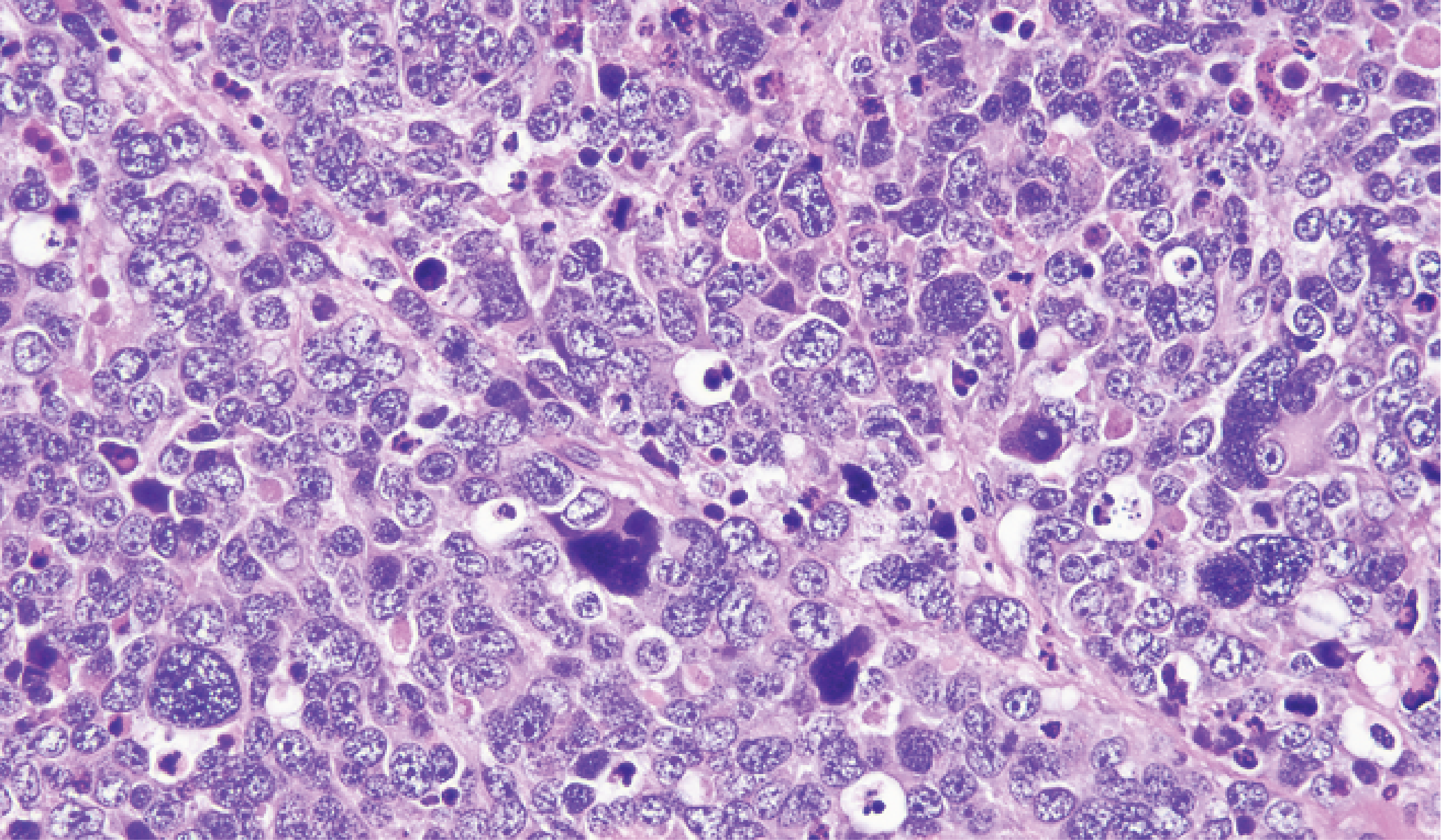 qarc medulloblastoma atlas