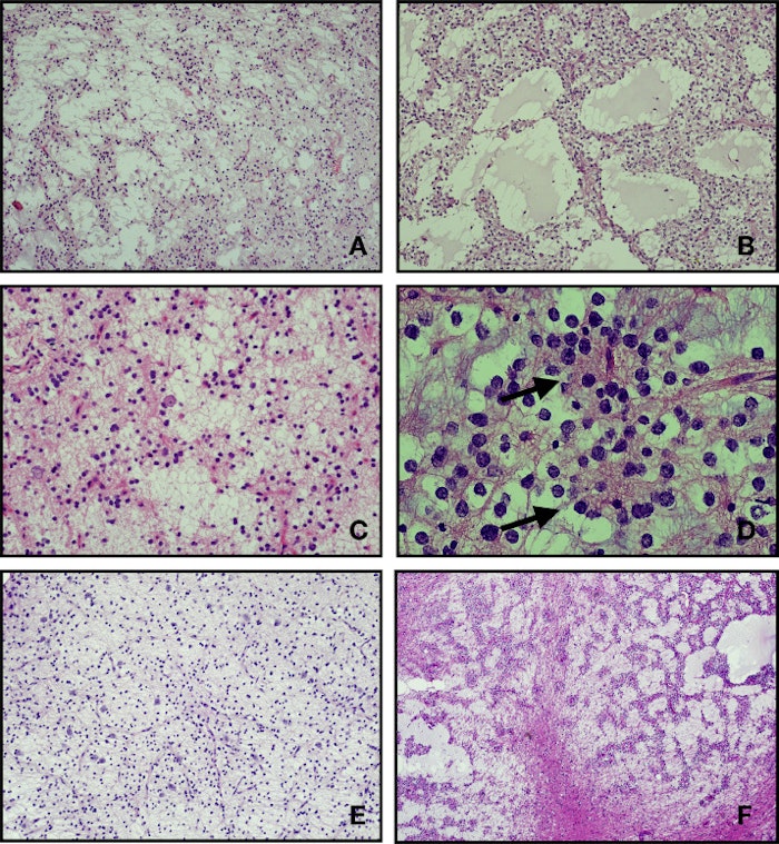 Myxoid glioneuronal tumor