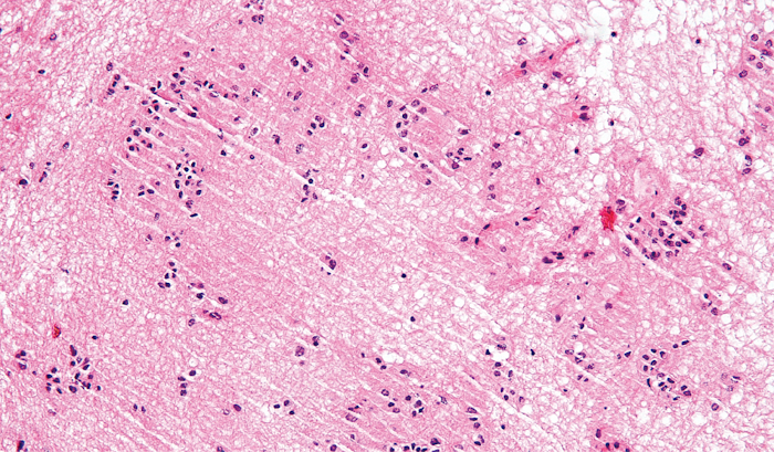 Subependymal Giant cell Astrocytoma.png
