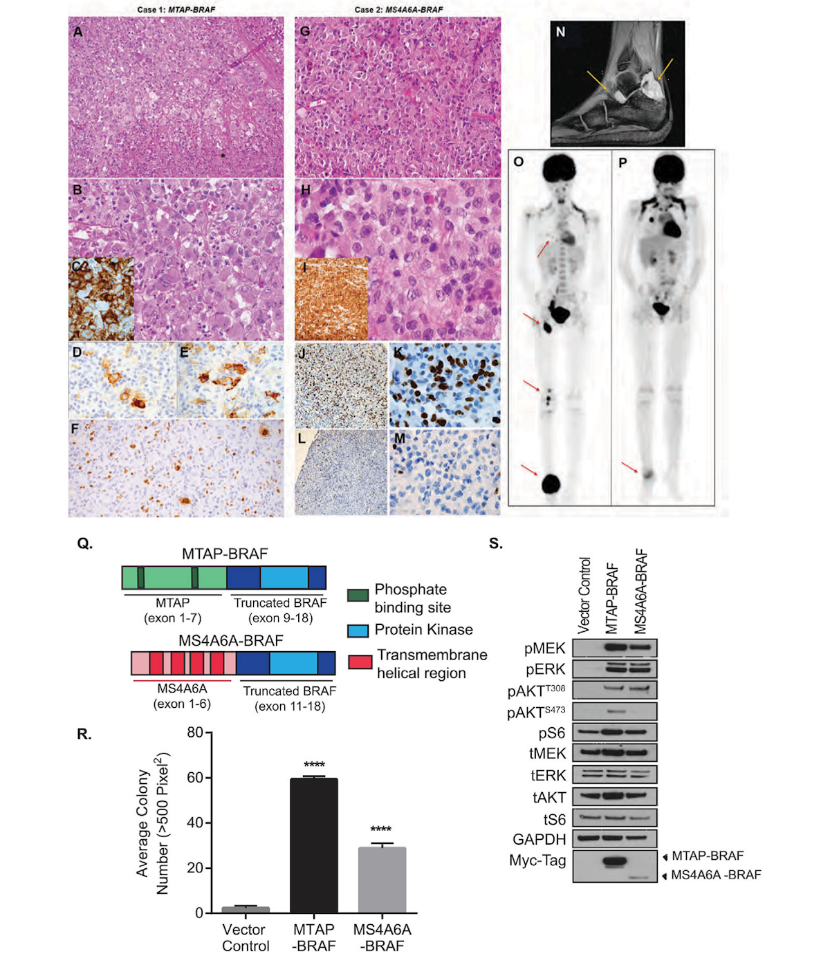 BRAF Fusions in Pediatric Histiocytic Neoplasms Define Distinct